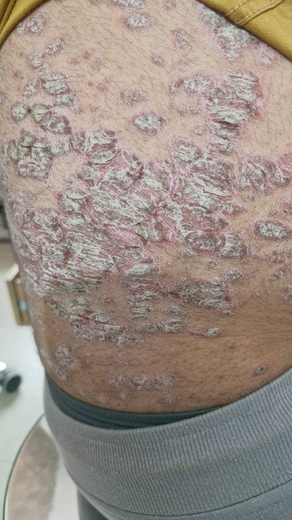 Skin Disease