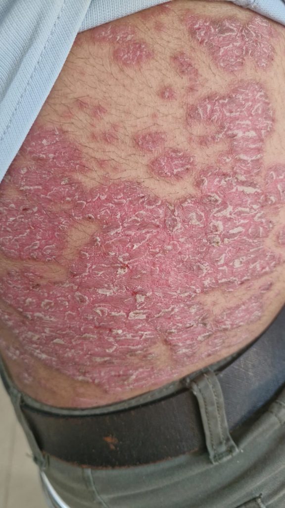 Skin Disease