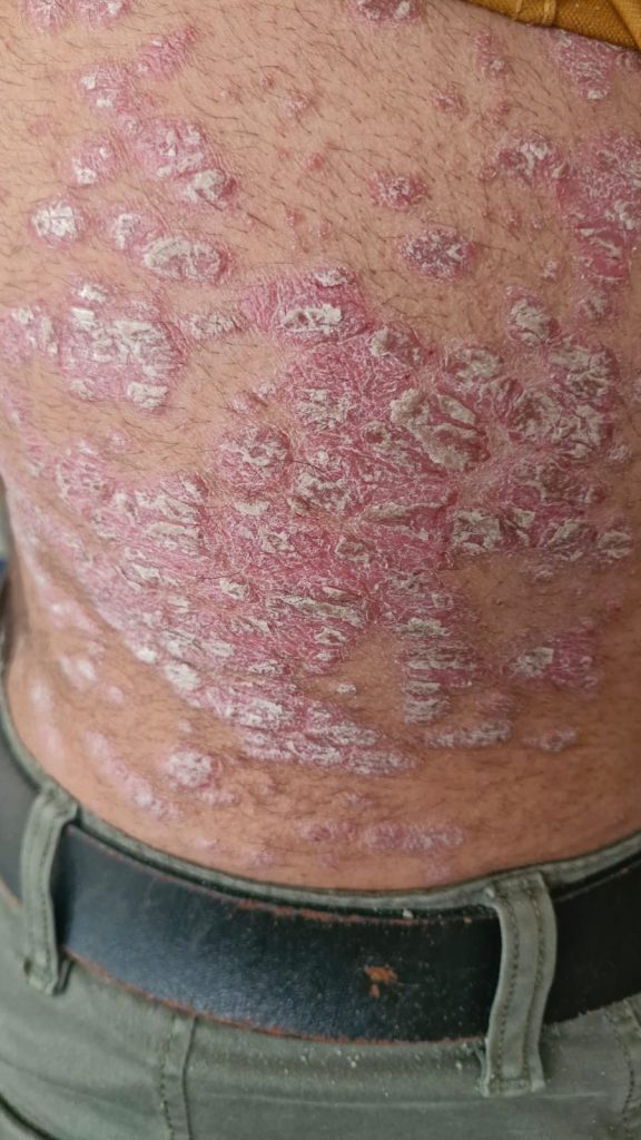 Skin Disease