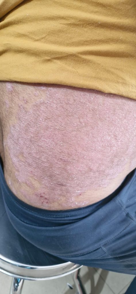 Skin Disease
