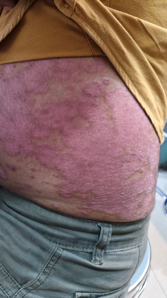 Skin Disease